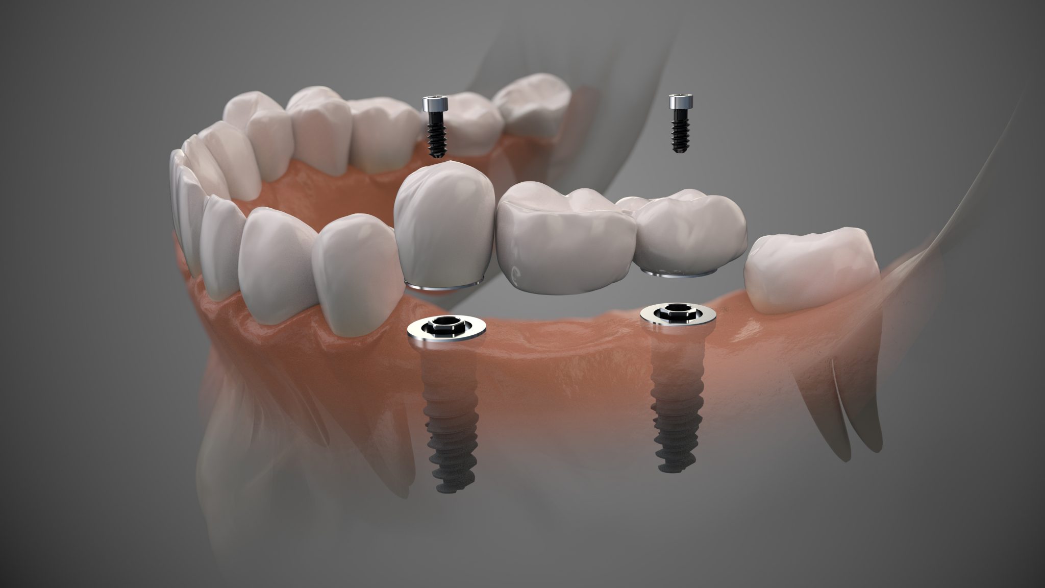 Three Ways Dental Implants Can Restore Your Grin Prosthodontist In